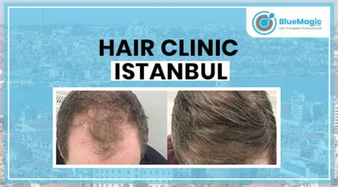 Turkish price for blue magic hair transplant